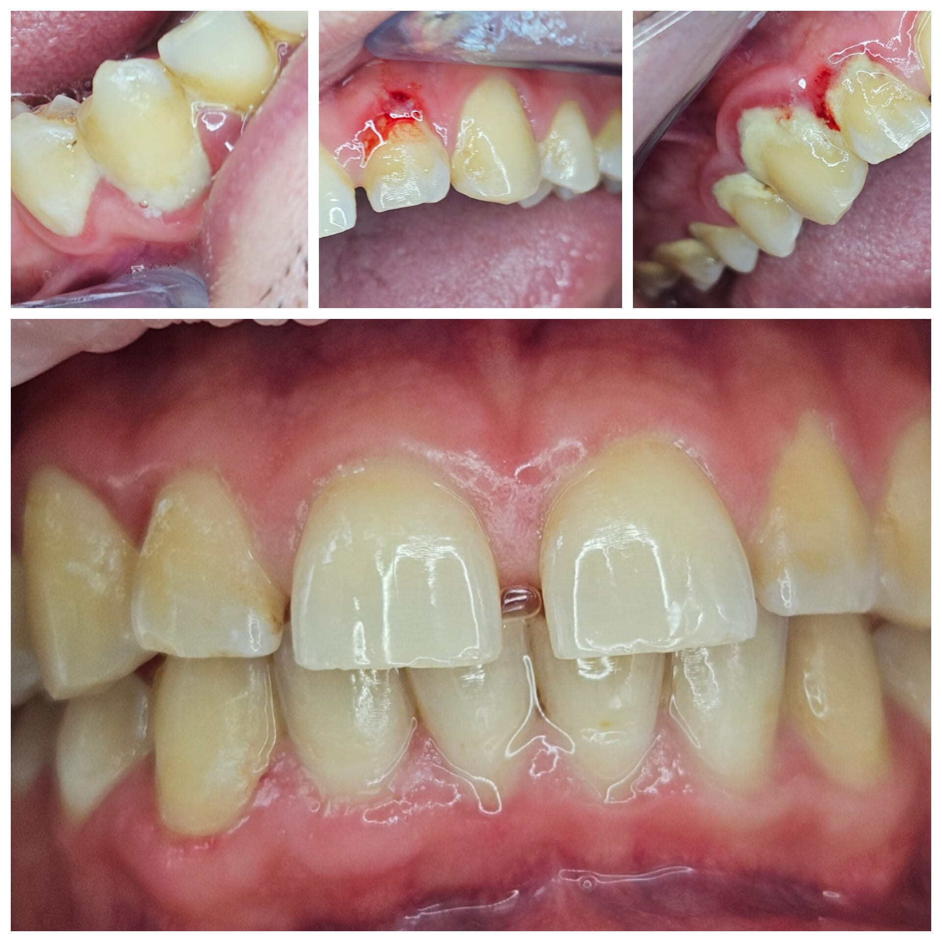 Tratament Invisalign 2