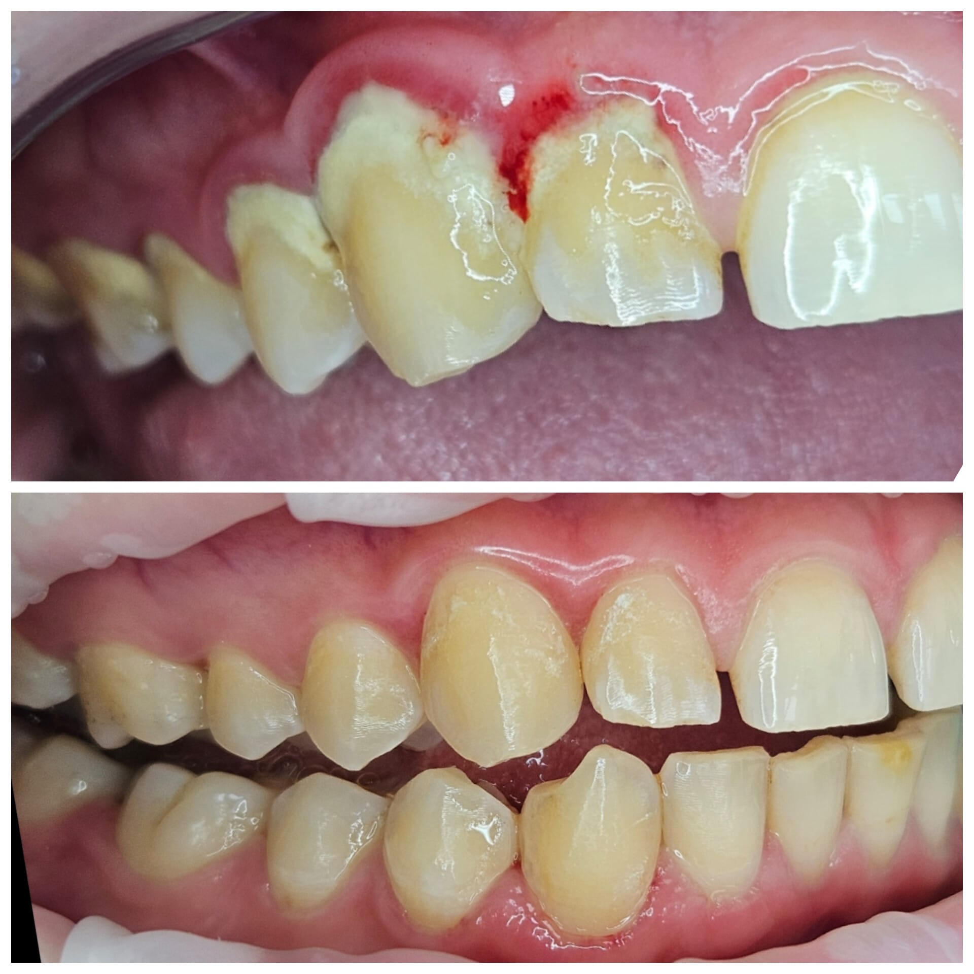 Tratament Invisalign 3