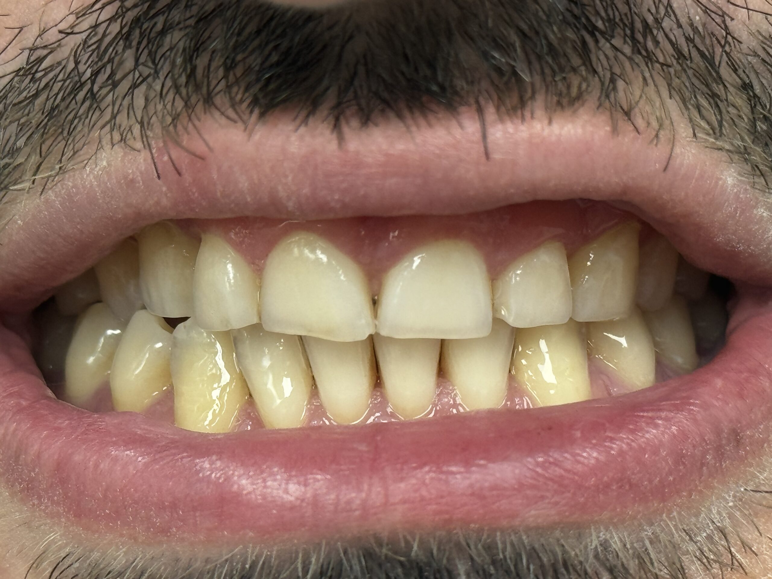 Tratament Invisalign 1