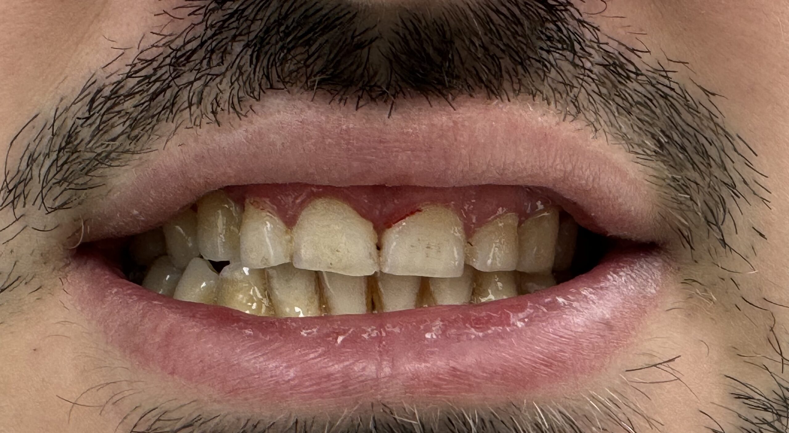 Instrucțiuni folosire Invisalign