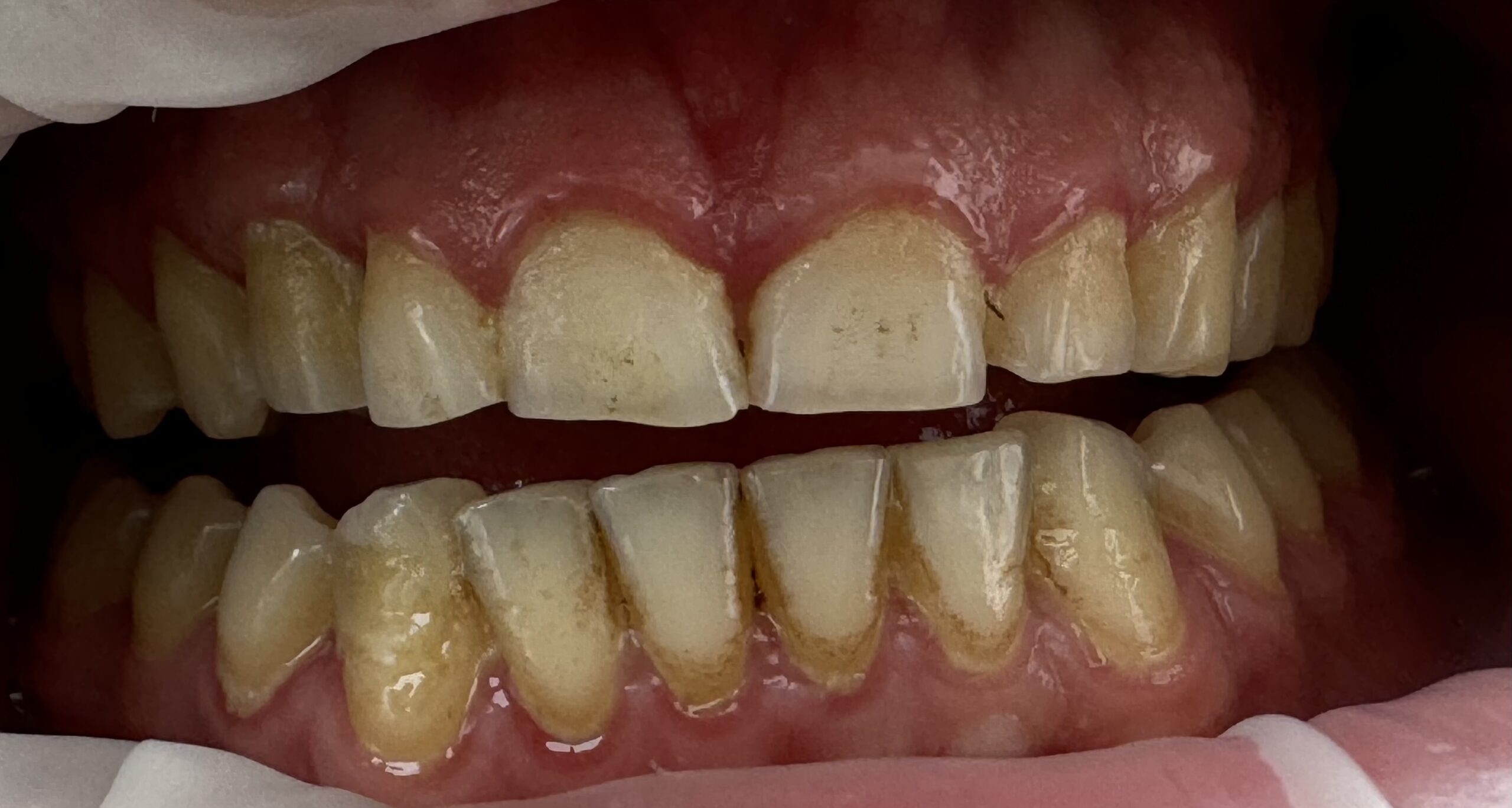 Tratament Invisalign pentru alinierea dinților